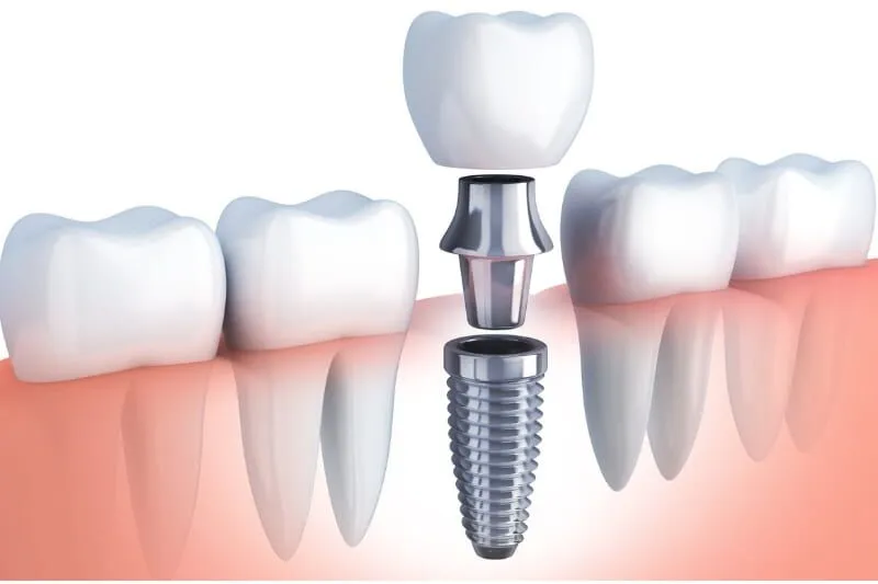 Transforme su sonrisa: Tres razones convincentes para considerar los implantes dentales