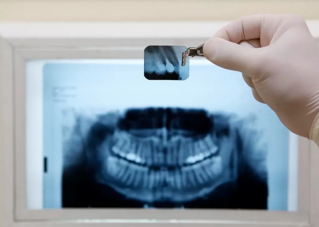 Todo Sobre Las Radiografías Dentales: Lo Que Necesita Saber
