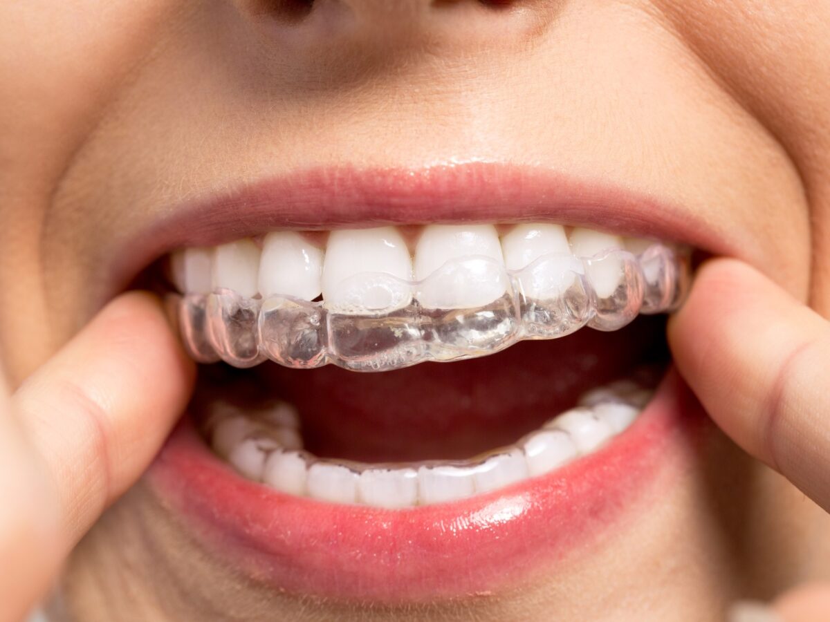 Lo que me hubiera gustado saber antes de empezar con Invisalign: una guía personal