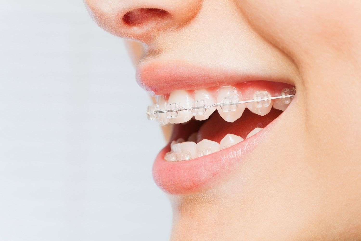 Innovaciones en ortodoncia: más allá de los brackets tradicionales