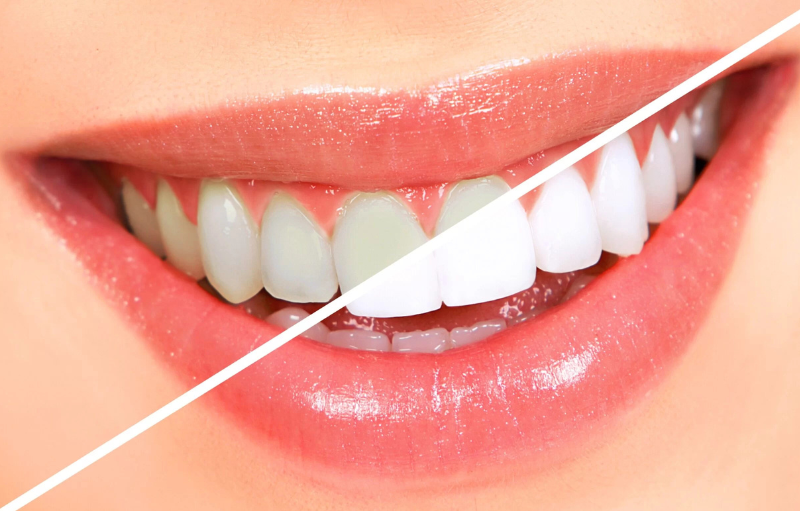 Descubra una sonrisa más brillante: todo sobre el blanqueamiento dental