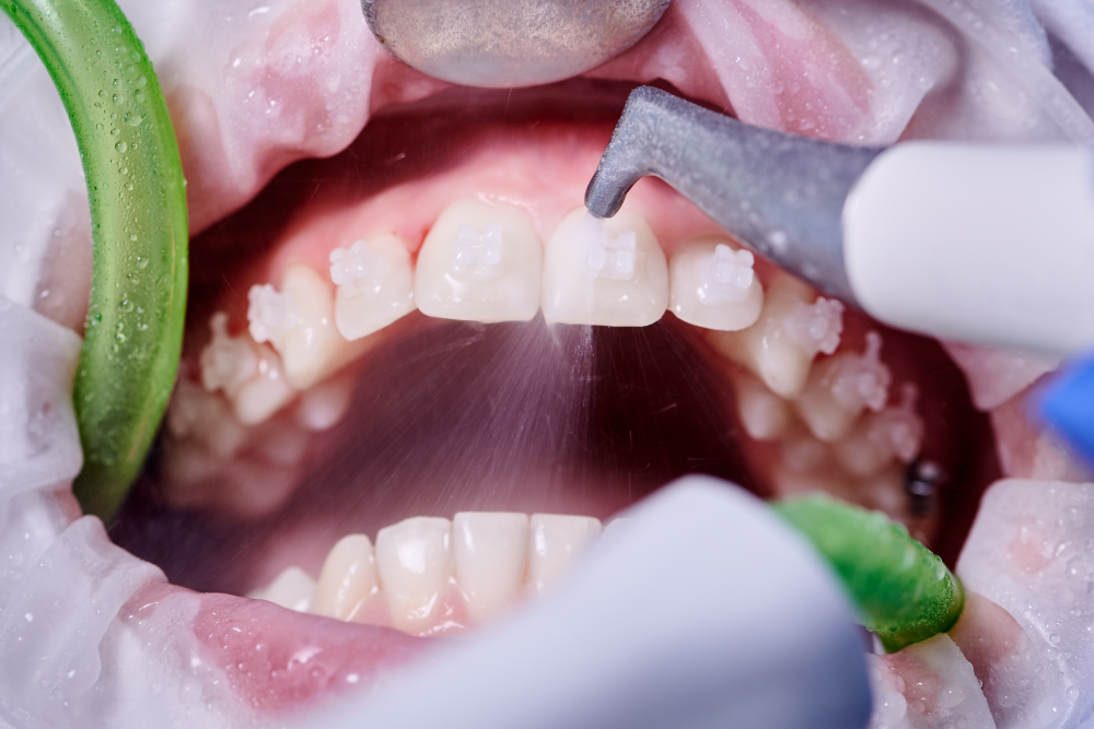 Los mejores consejos para mantener una sonrisa perfectamente limpia