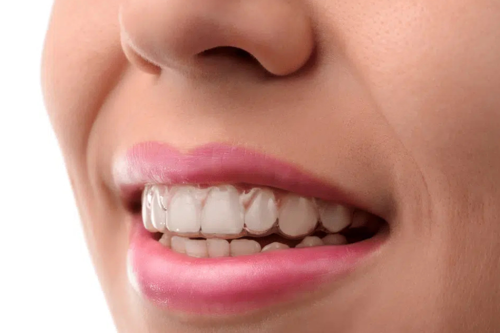 Consiga una sonrisa perfecta con Invisalign: la alternativa transparente a los brackets