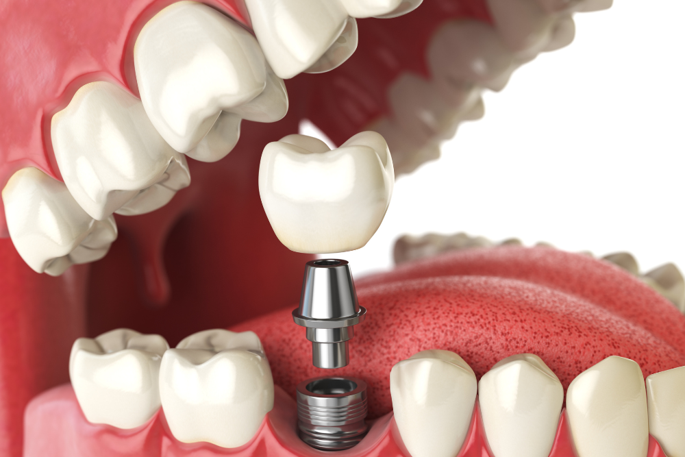 Recupere su sonrisa con implantes dentales en Caring Family Dentistry