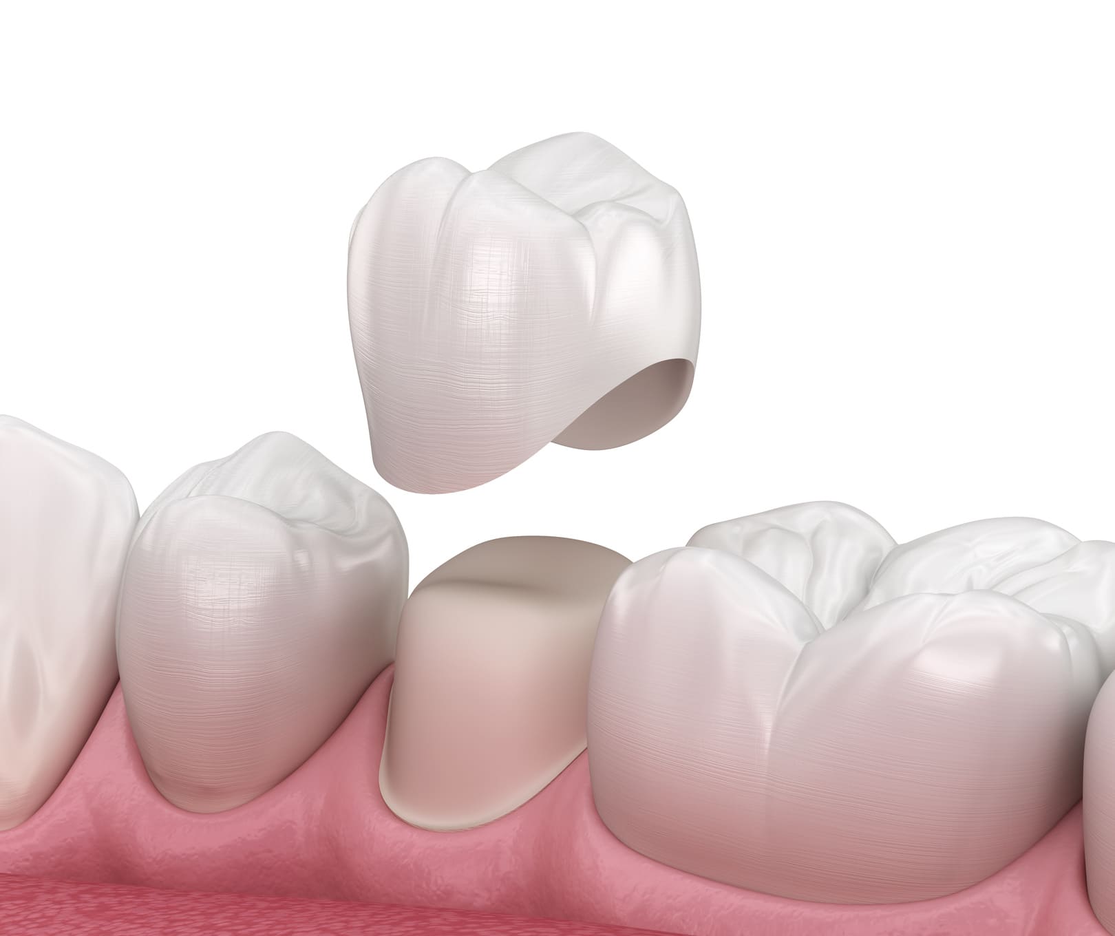 ¿Qué es una corona dental y cuándo la necesitas?