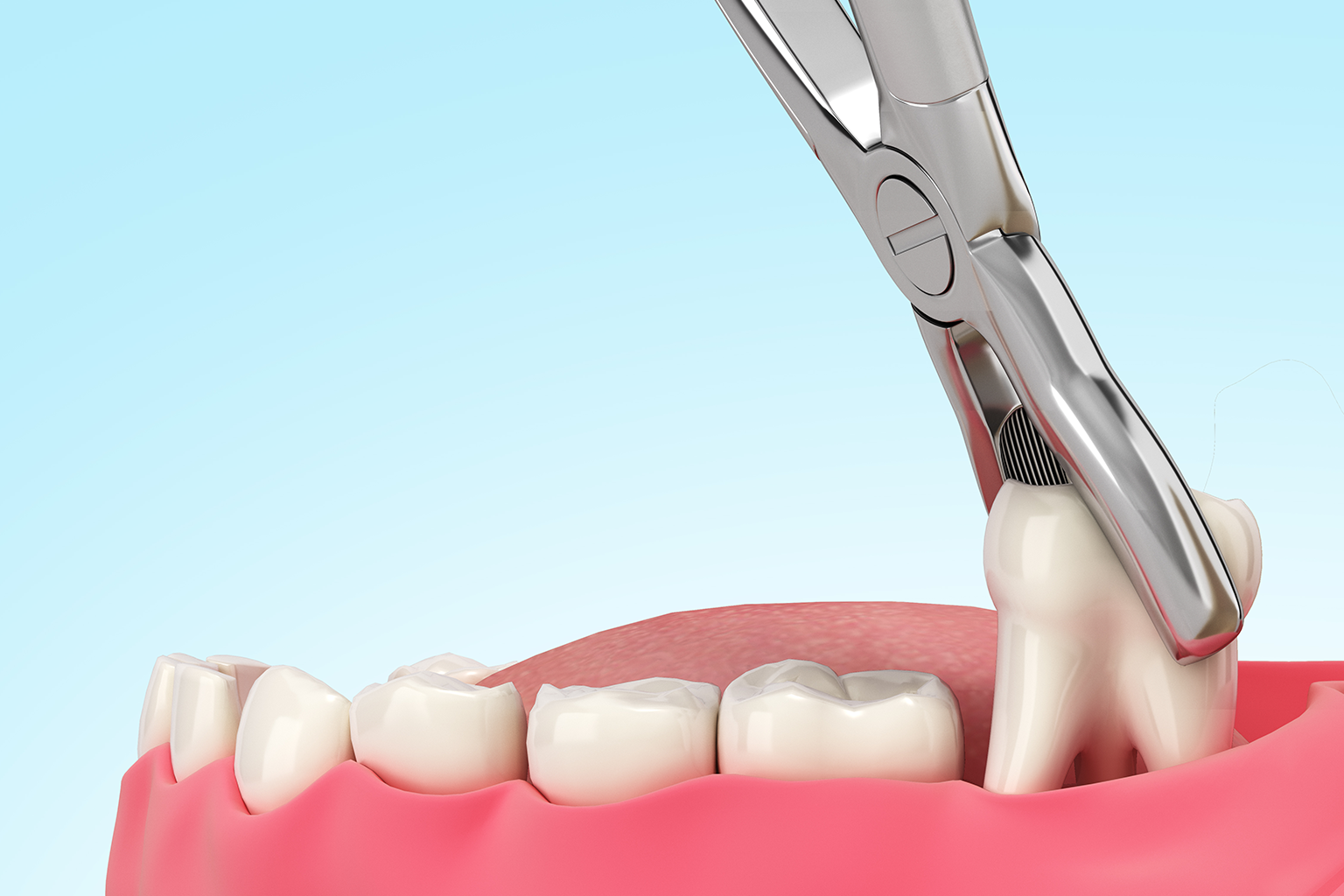 Qué hacer después de una extracción dental: consejos esenciales de cuidado