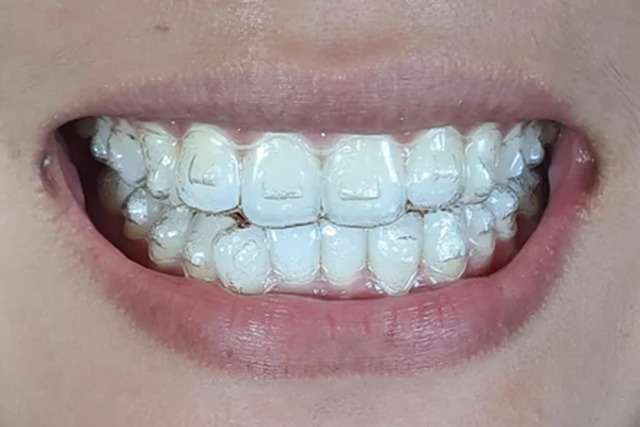 Transforma tu sonrisa con brackets invisibles: Por qué Invisalign es el futuro de la ortodoncia