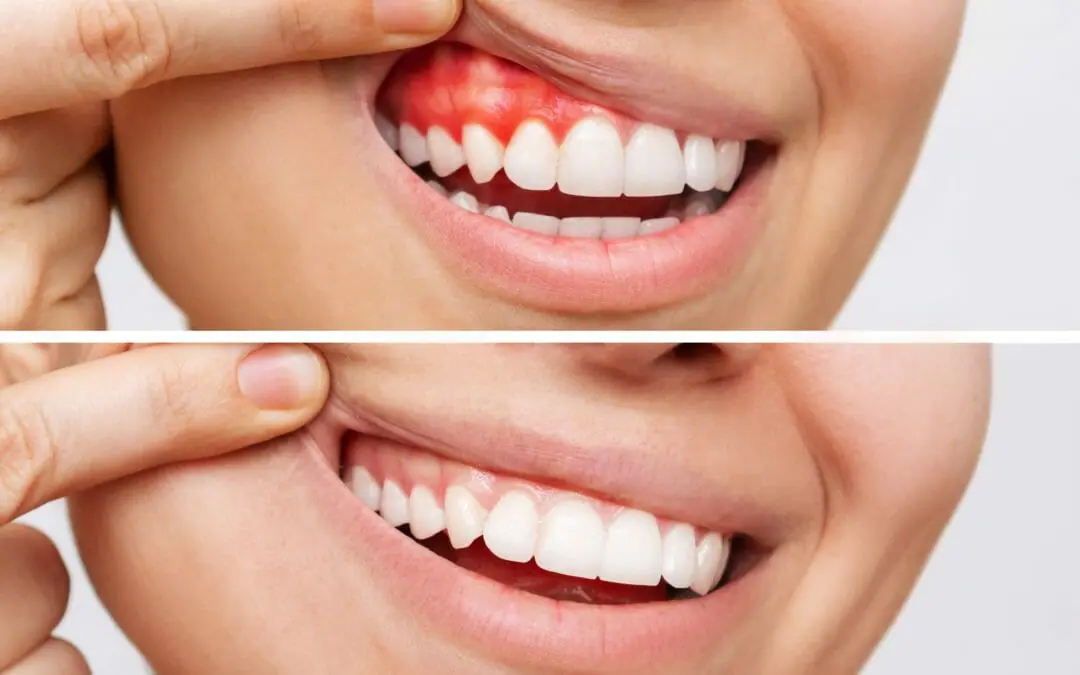 Entendiendo la enfermedad periodontal y cómo la Dra. Monica Morgan puede ayudar