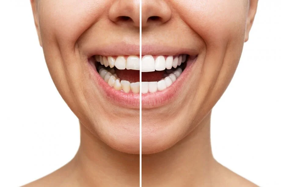 La durabilidad y el cuidado de las carillas dentales
